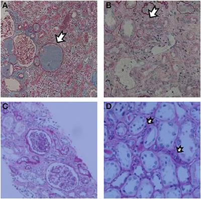 COQ8B glomerular nephropathy: Outcomes after kidney transplantation and analysis of characteristics in Chinese population